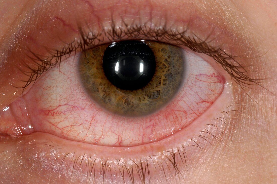 Acute conjunctivitis of the eye