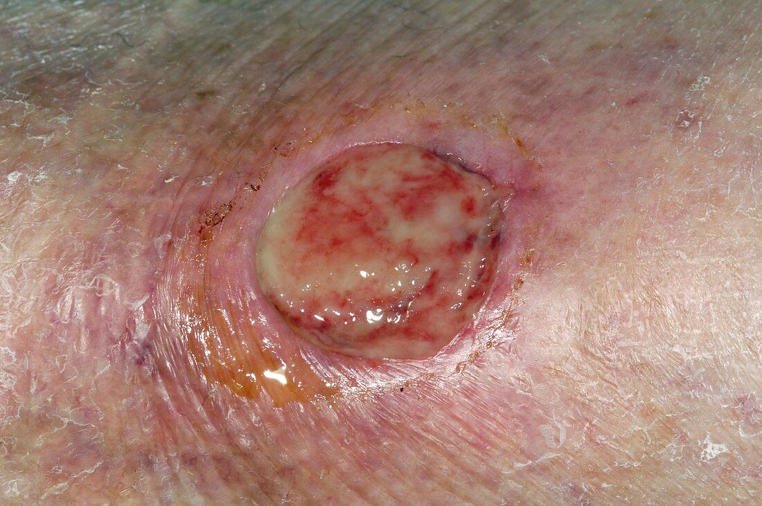Infected ulcer on the shin