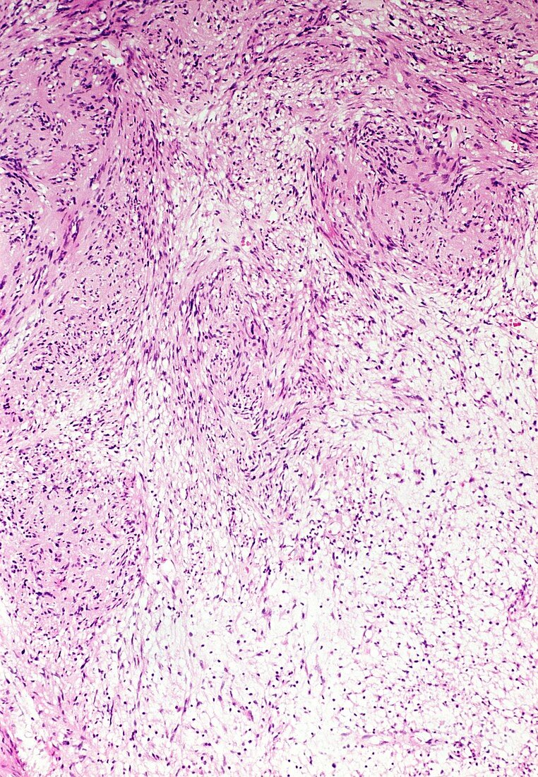 Schwann cell tumour,light micrograph