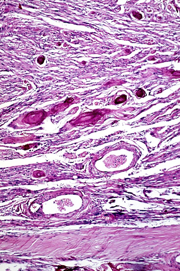 Meningioma tumour,light micrograph