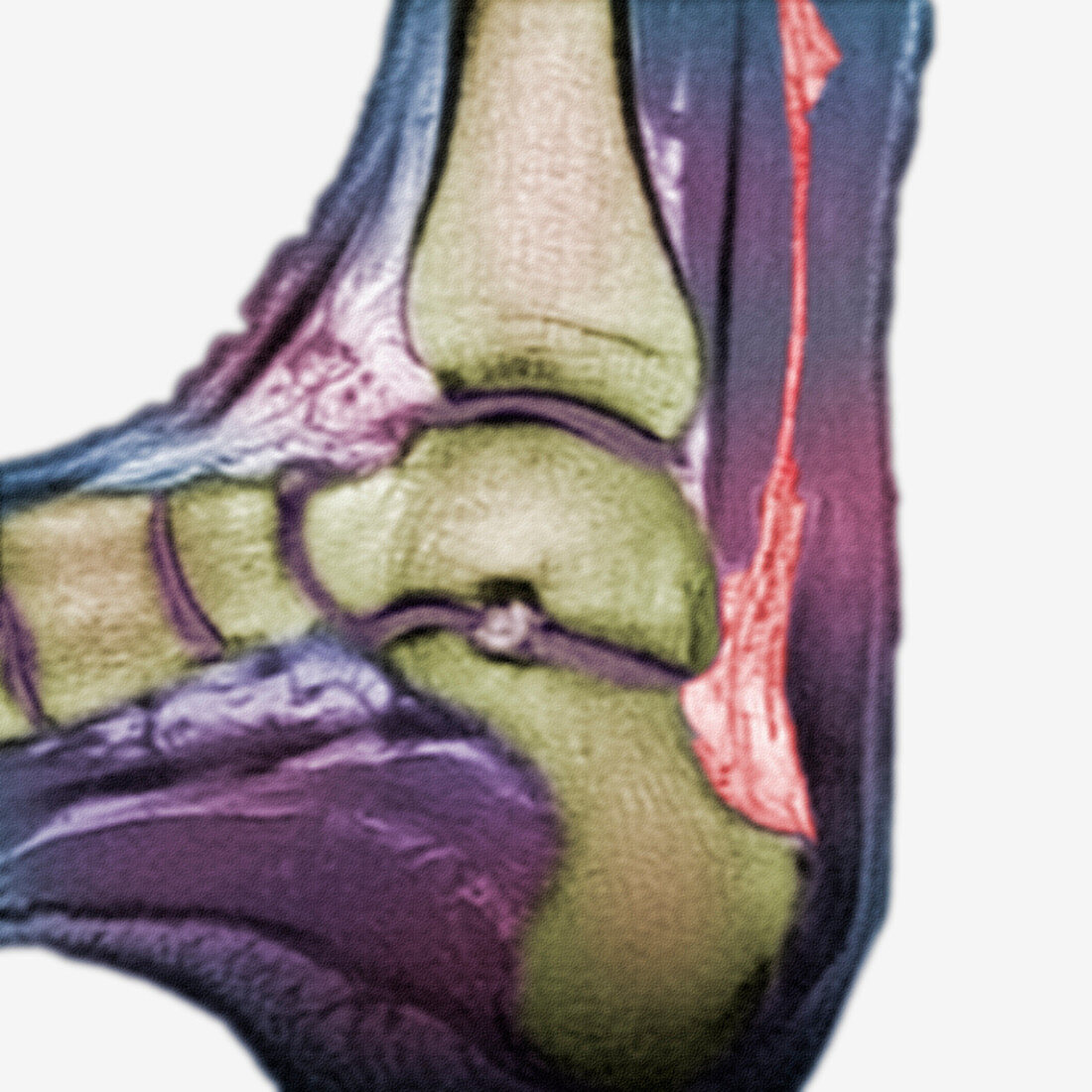 MRI of a rupture of the Achilles Tendon