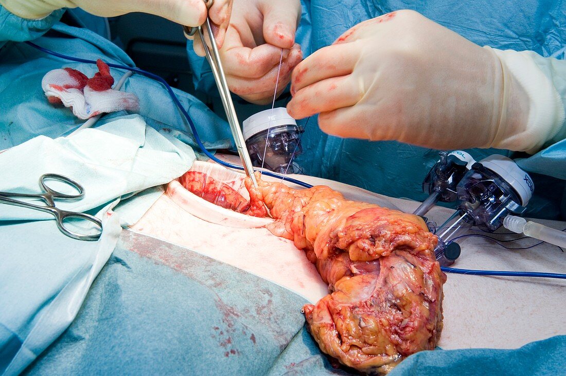 Laparoscopic colon cancer surgery