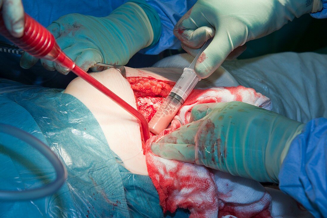 Failed hip replacement surgery
