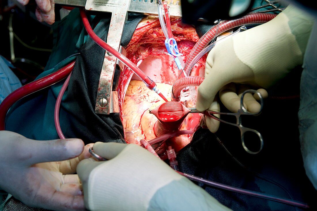 Aorta surgery