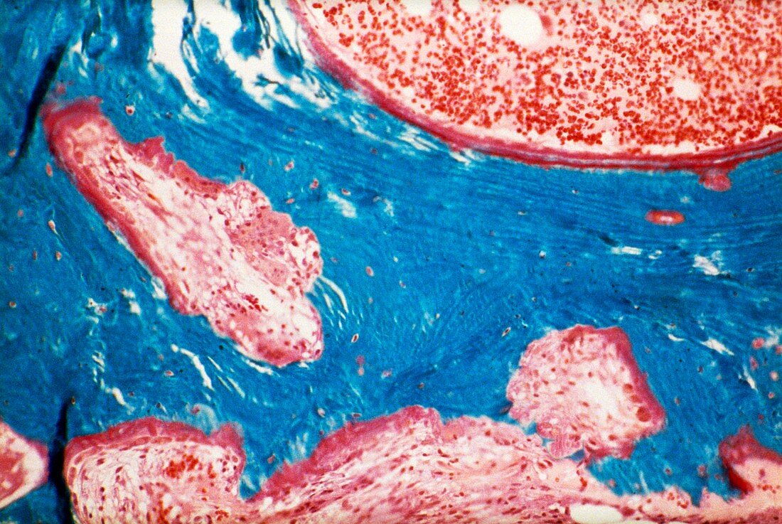 Paget's disease,light micrograph