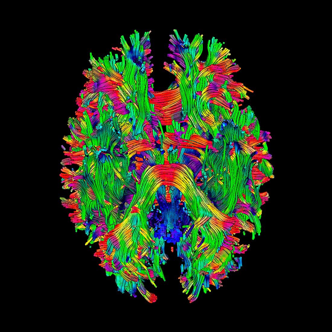 Brain tumour,DTI scan