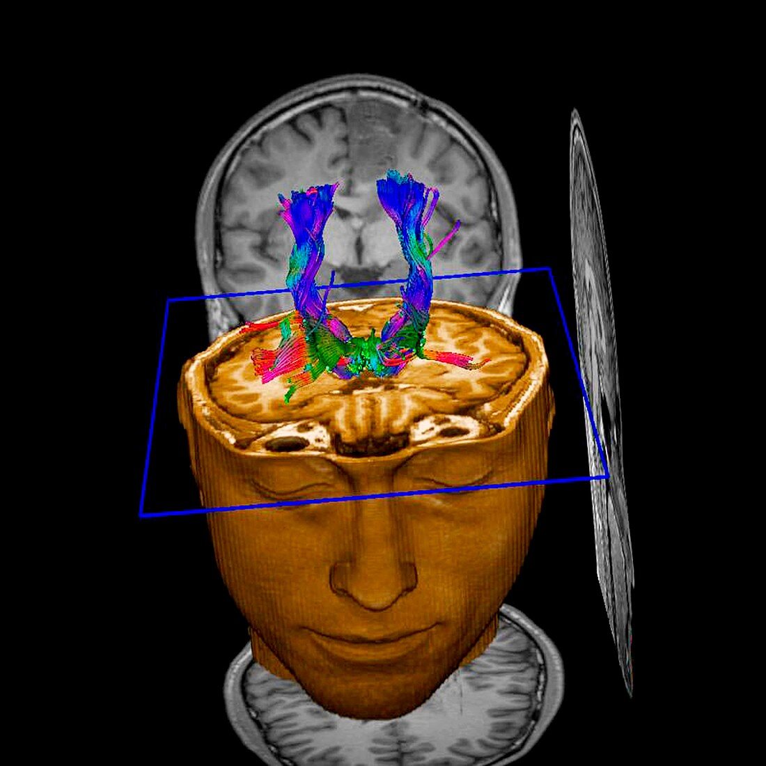 Brain tumour,DTI and MRI scans