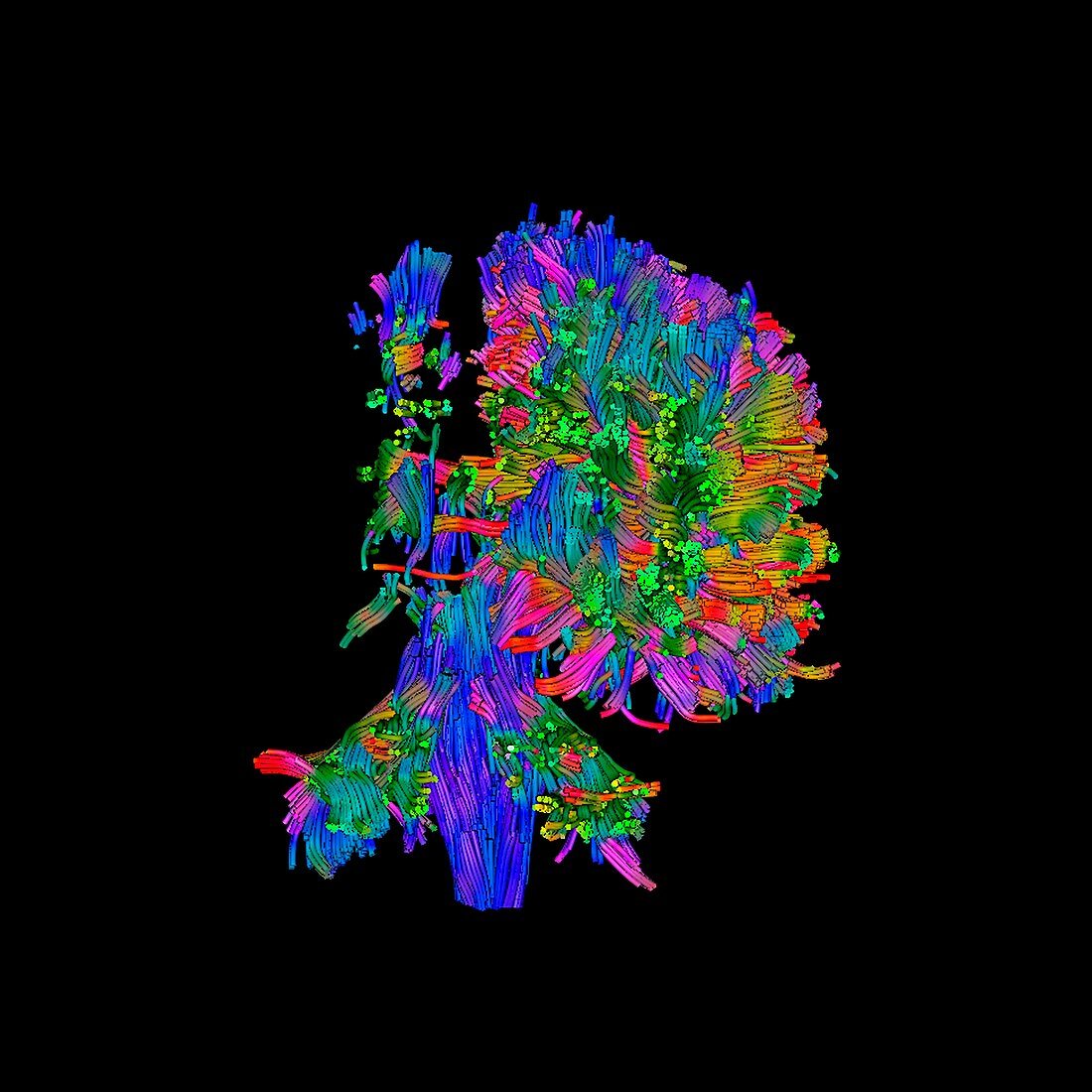 Cerebral palsy,DTI scan