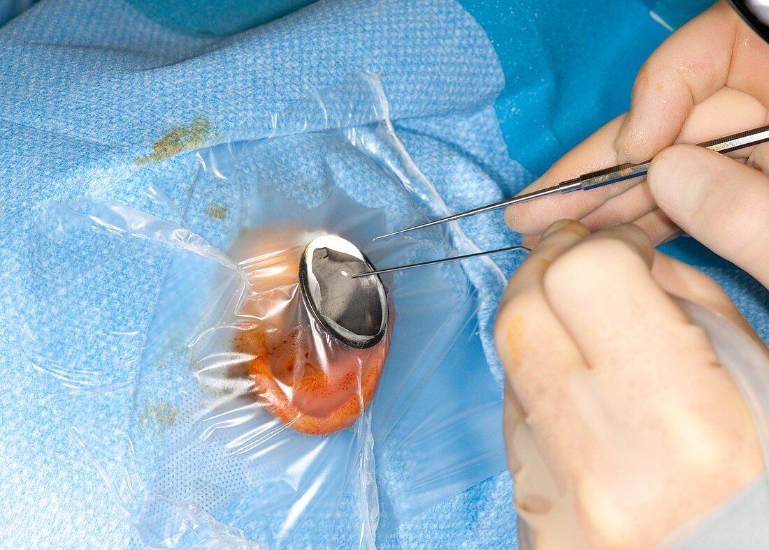 Middle ear surgery
