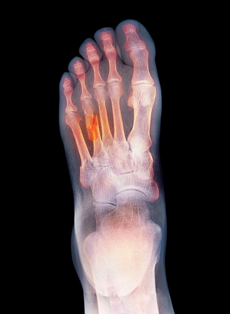 Fractured foot,X-ray