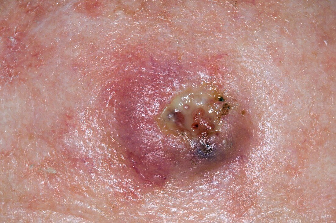 Squamous cell cancer on forehead