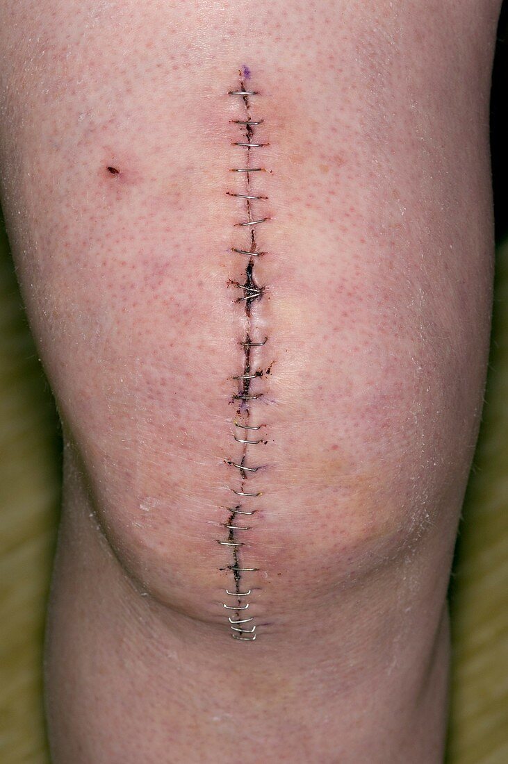 Total knee replacement wound