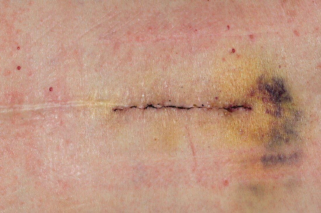 Scar from lumbar decompression