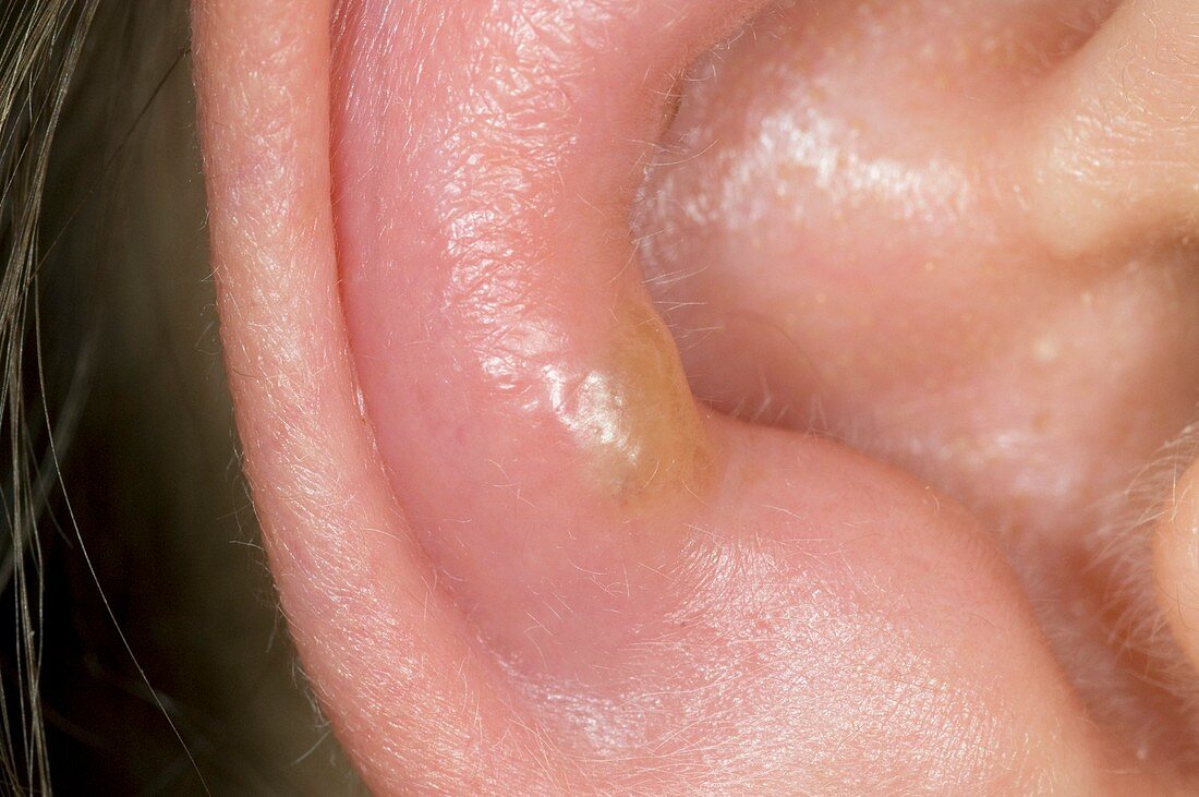Herpes simplex lesion on the ear