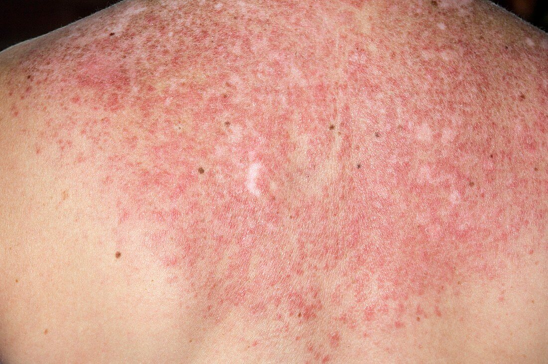 Lupus rash on back triggered by sun