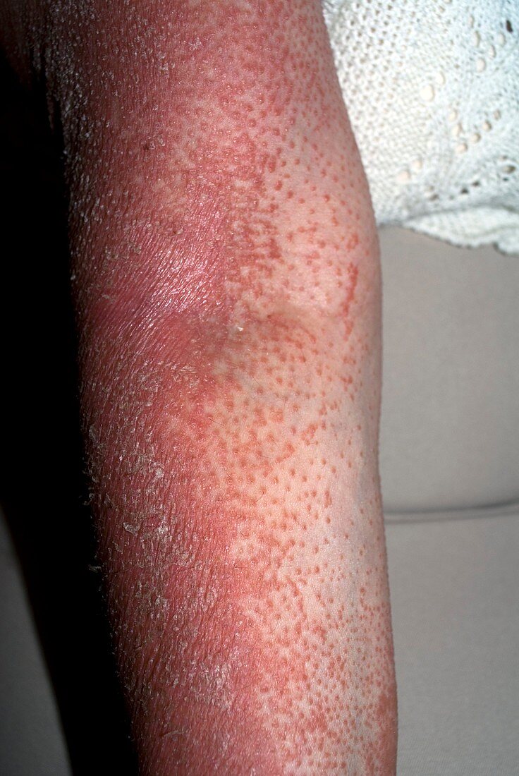 Pityriasis rubra pilaris