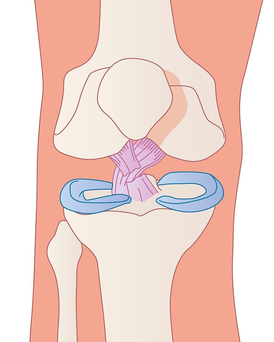 Damaged knee ligament,artwork