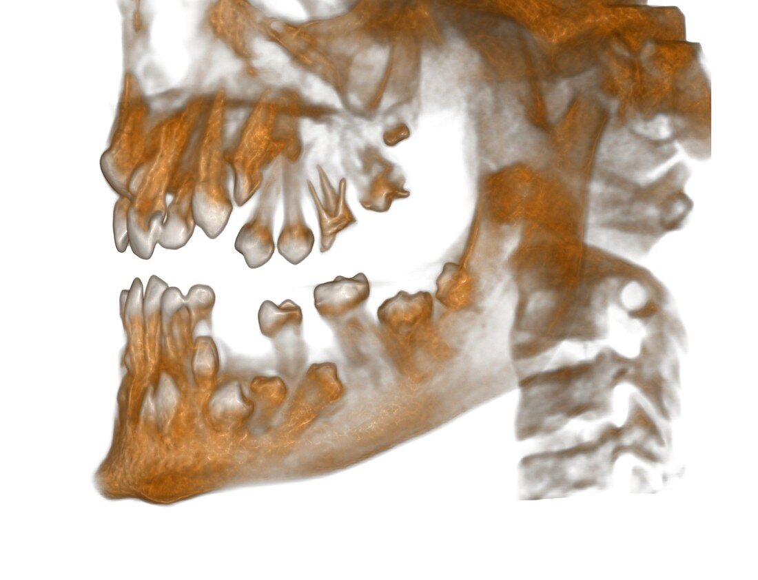 Cleidocranial dysplasia,3D CT scan