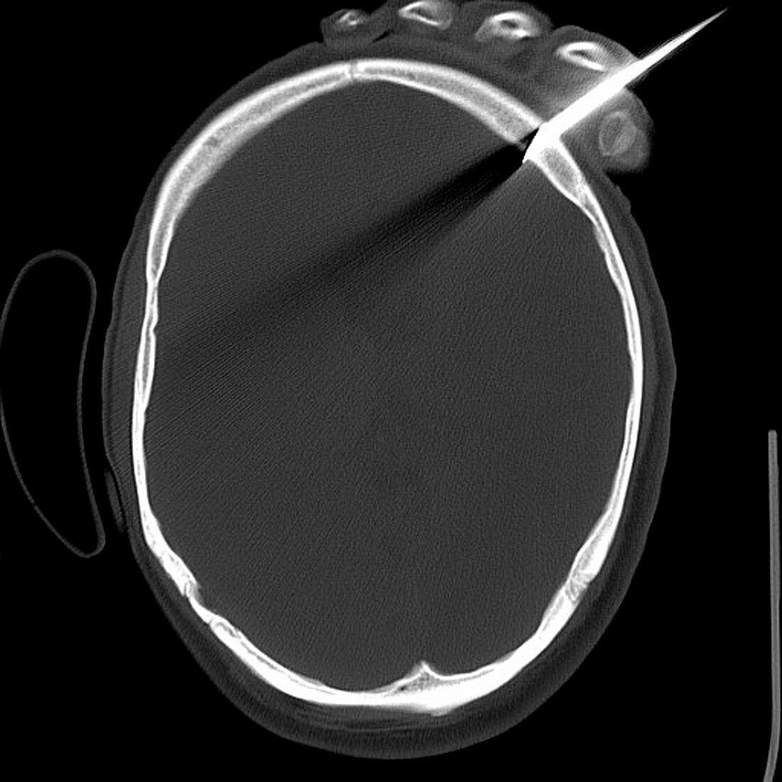 Knife in person's head,X-ray