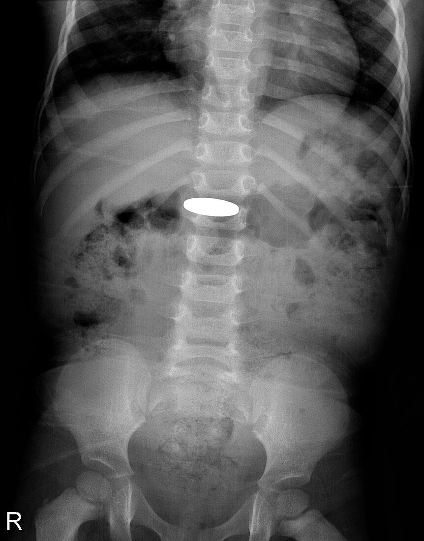Swallowed coin,X-ray