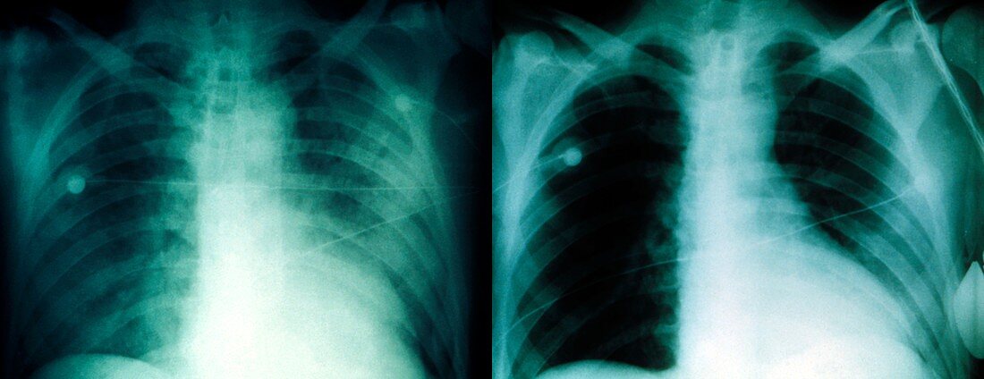 Pneumonic plague,X-ray