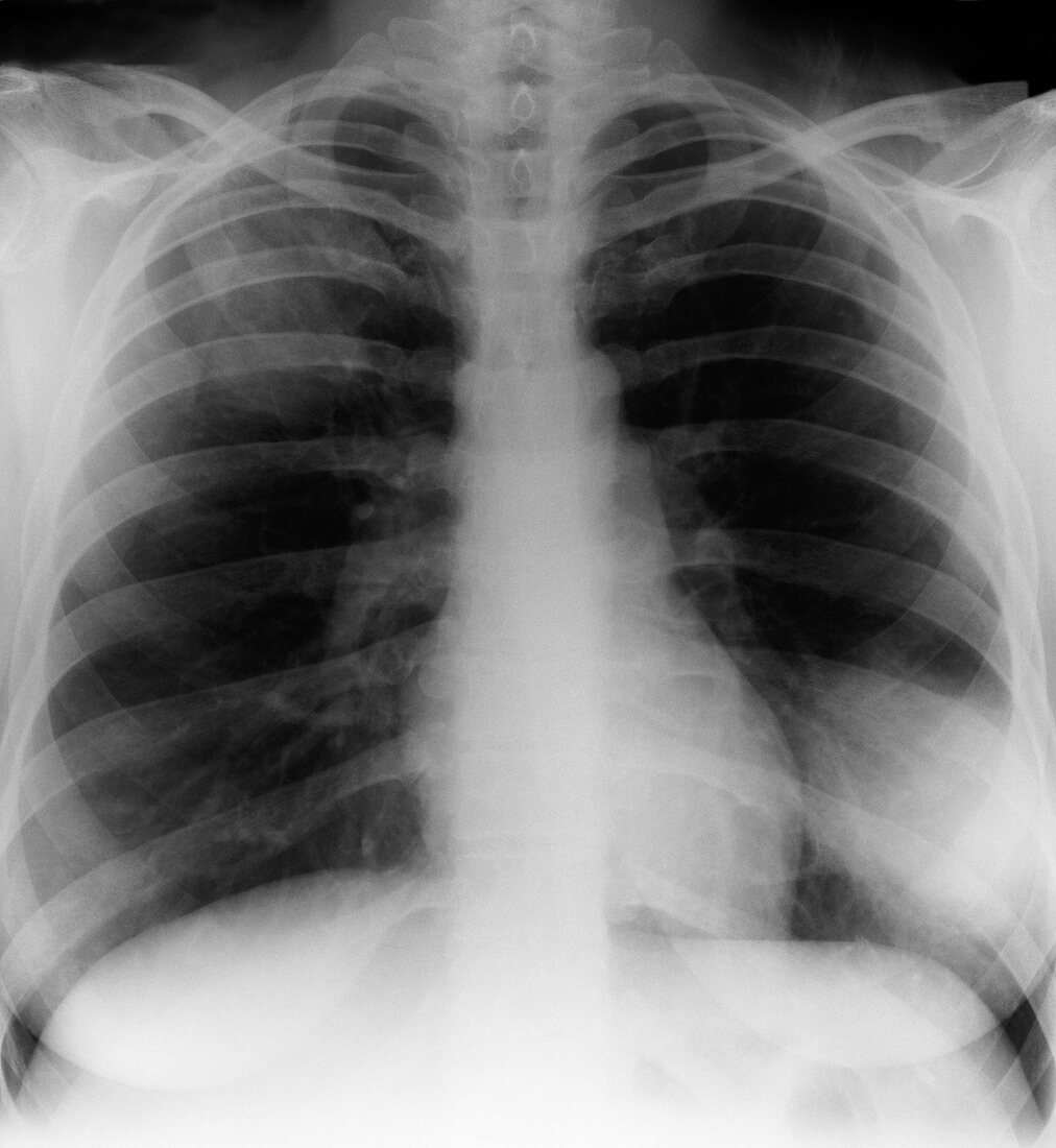 Pneumonia,X-ray