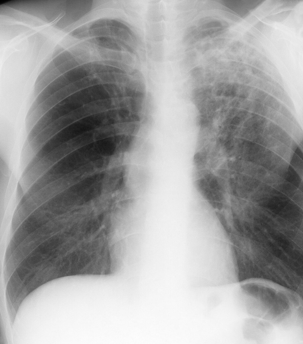 Old and new tuberculosis,X-ray