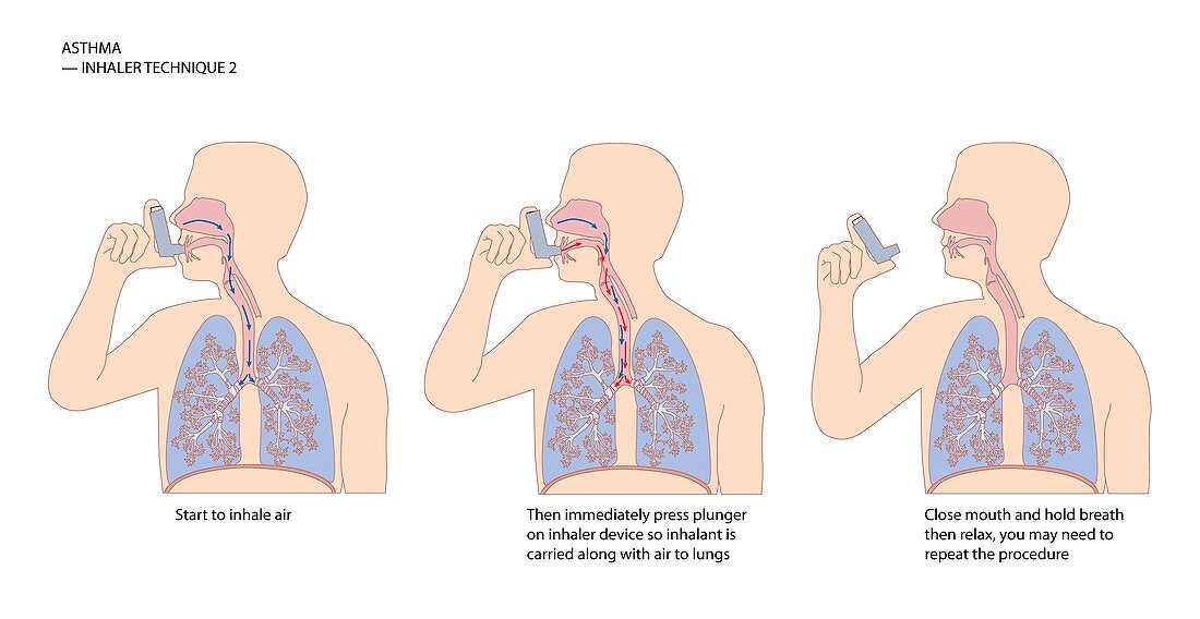 Asthma inhaler use,artwork