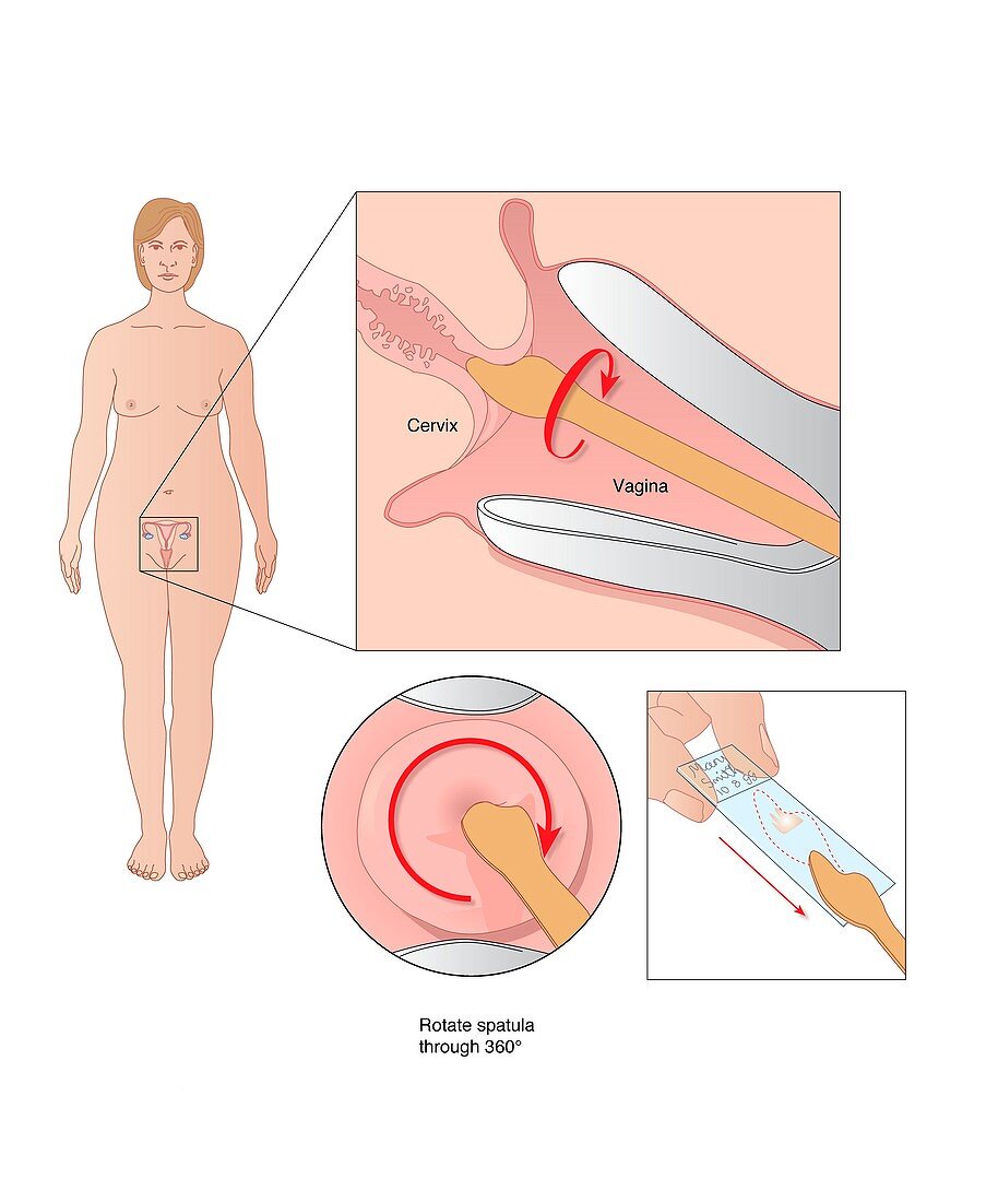 Cervical smear test,artwork