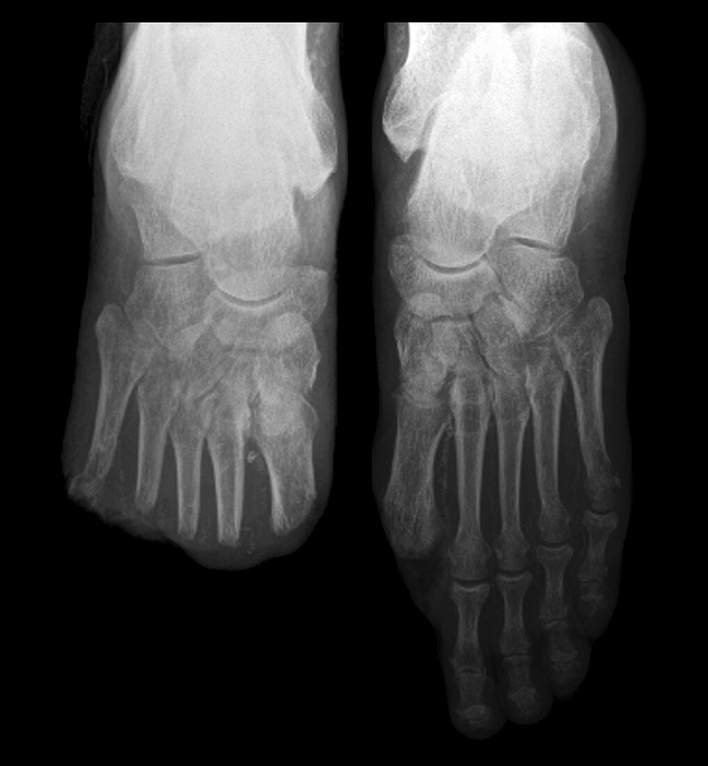 Toe amputations in diabetes,X-ray