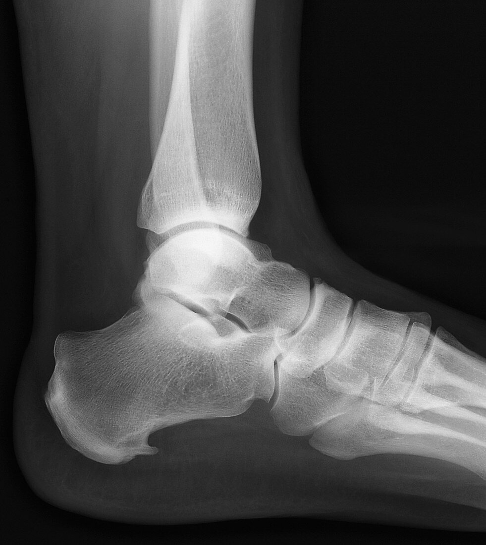 Heel bone spur,X-ray