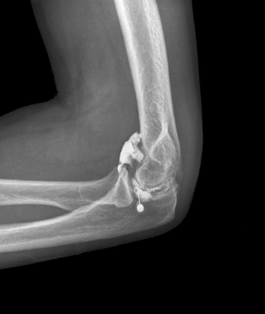 Elbow arthritis pain treatment,X-ray