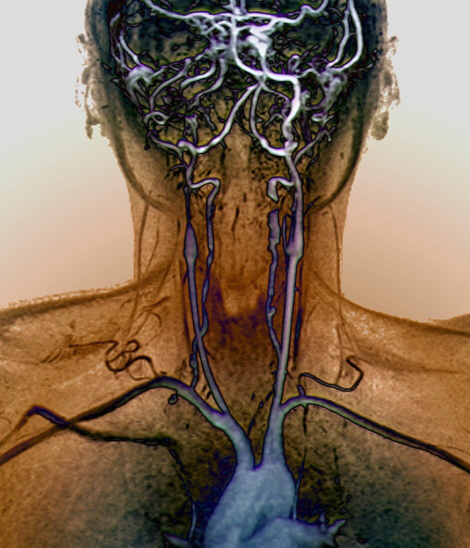 Neck and brain aneurysms,MRA scan