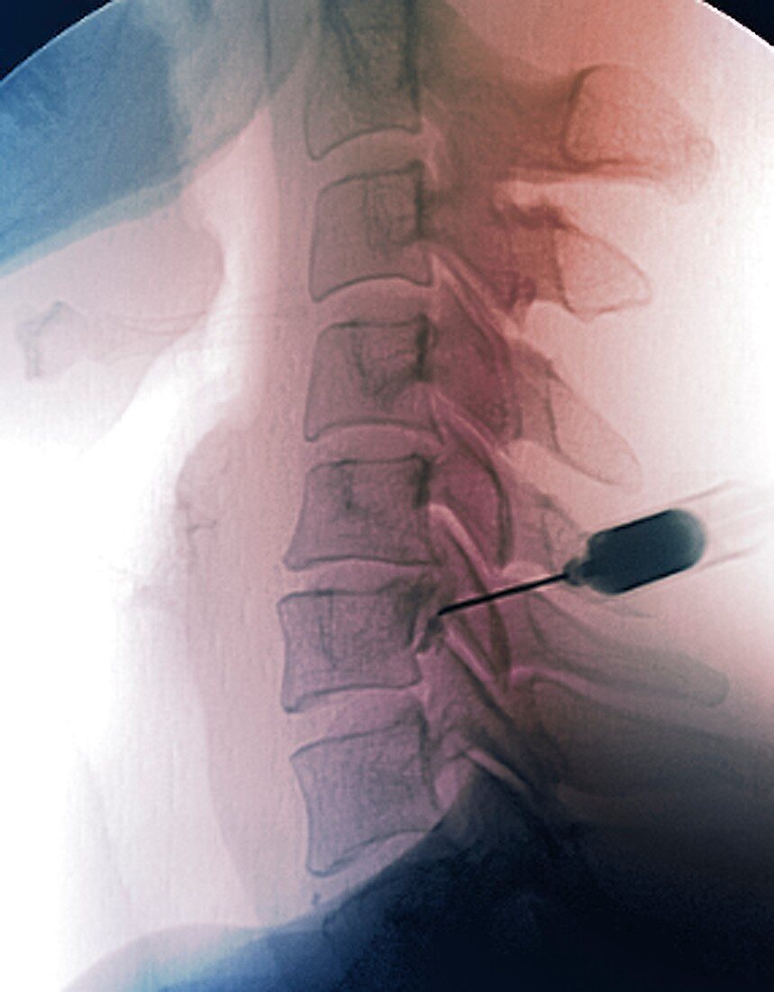 Neck pain treatment,X-ray