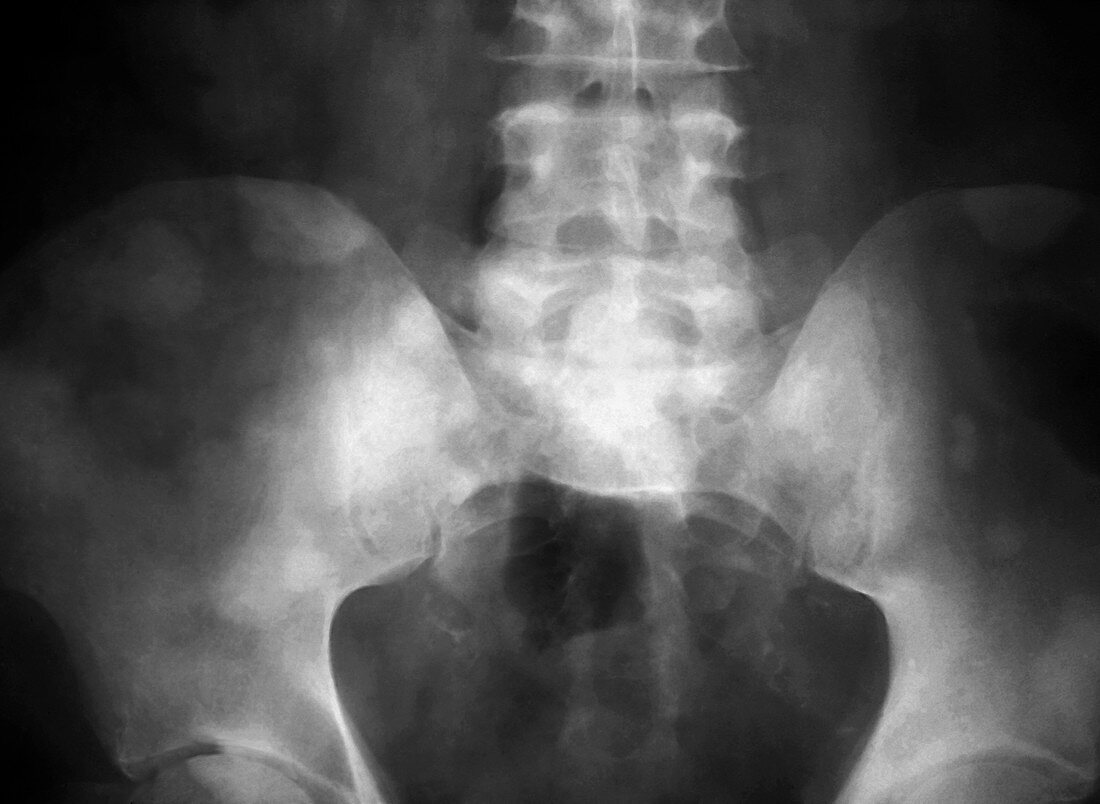 Secondary cancer in the pelvis,X-ray