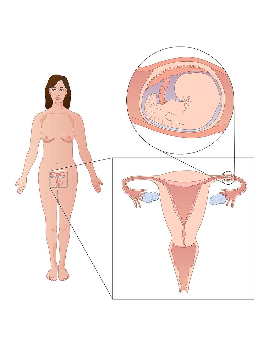 Ectopic pregnancy,artwork