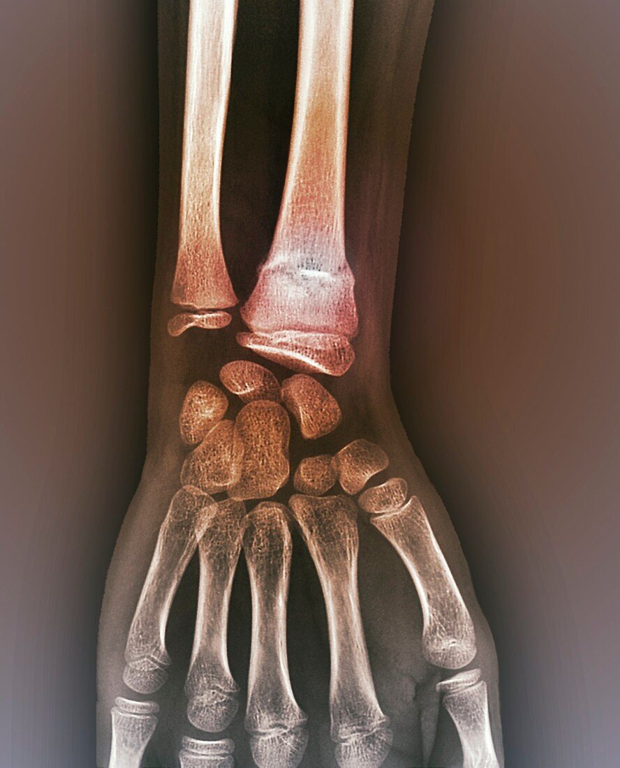 Healed arm bone fracture,X-ray