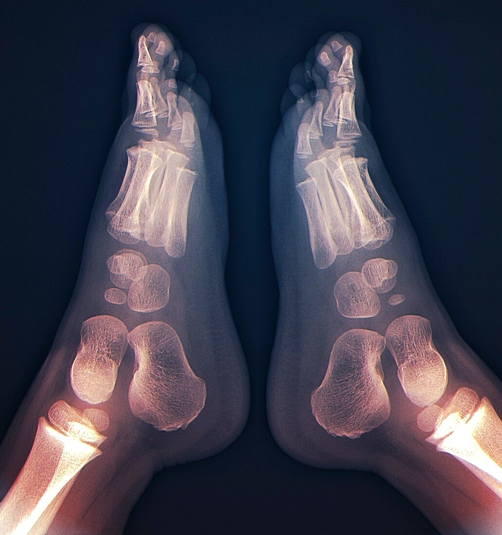 Childhood bone development,feet X-ray