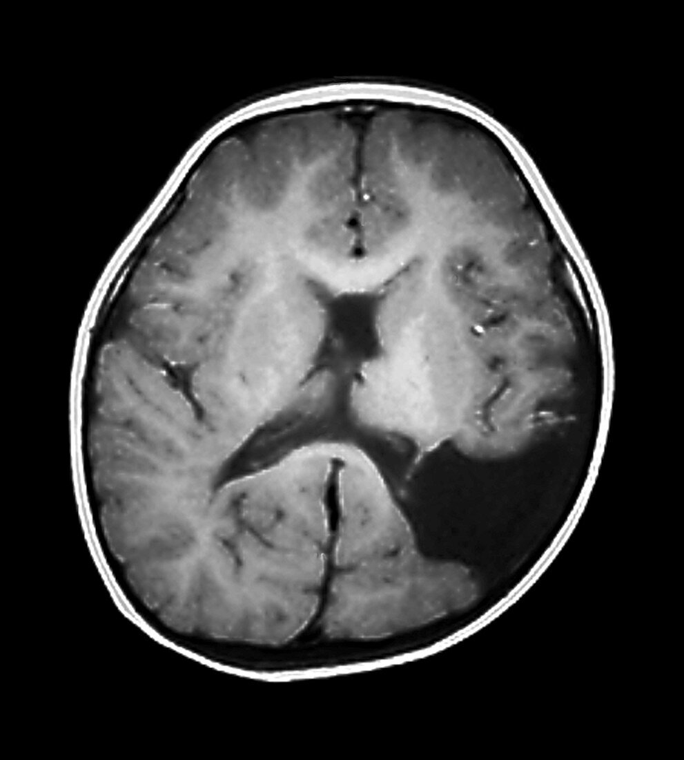 Schizencephaly disorder,MRI scan
