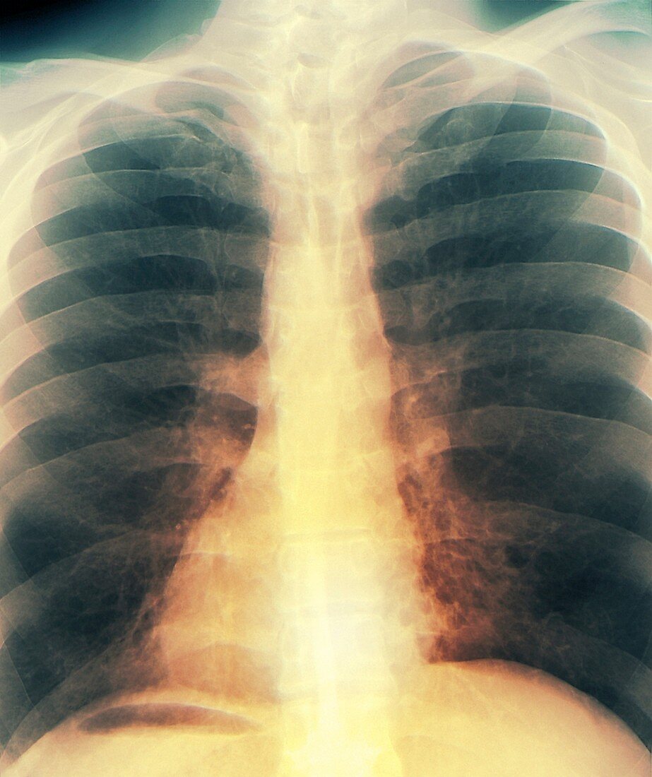 Kartagener Syndrome,X-ray