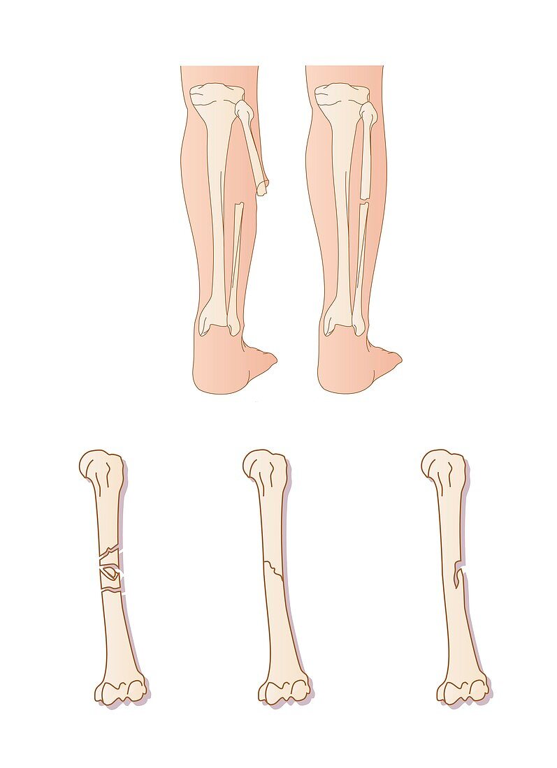 Types of fracture,artwork