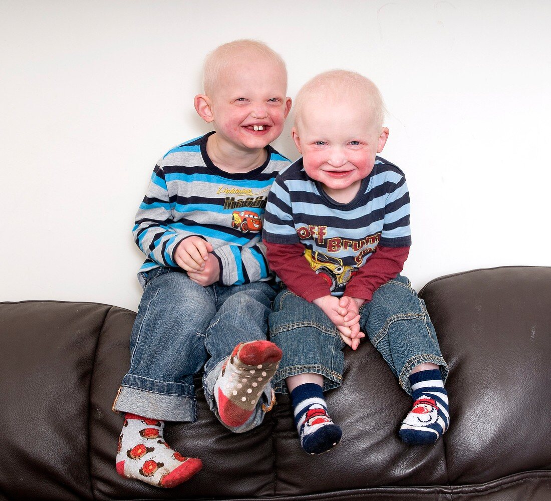 Brothers with ectodermal dysplasia