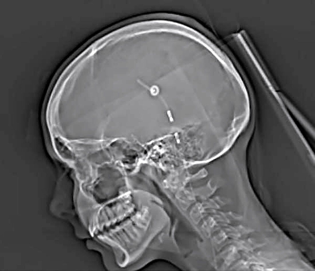 X-ray showing brain shunt draining cyst