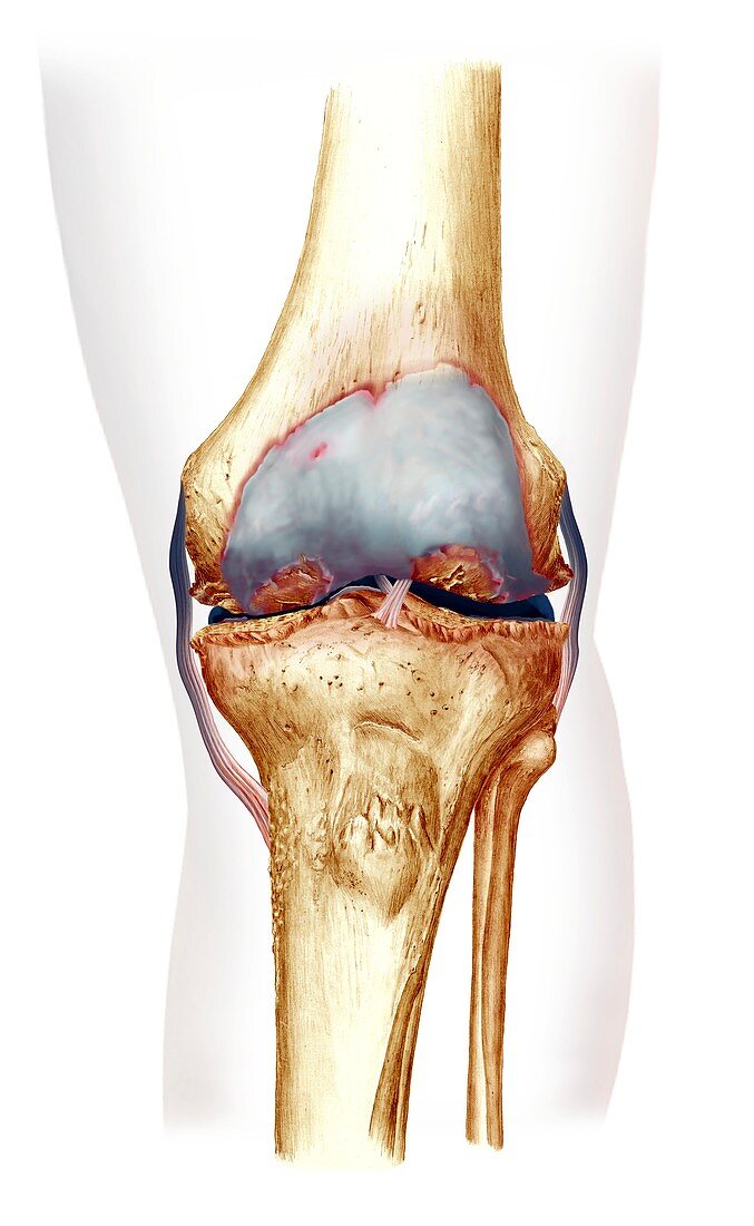 Damaged knee,artwork