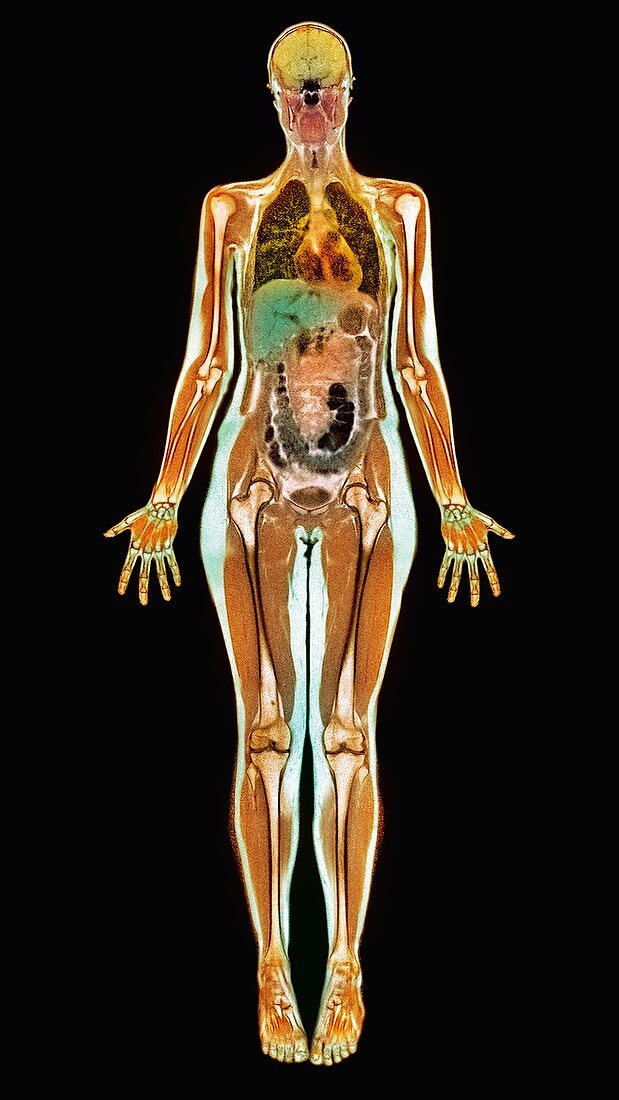 Thin woman,MRI scan