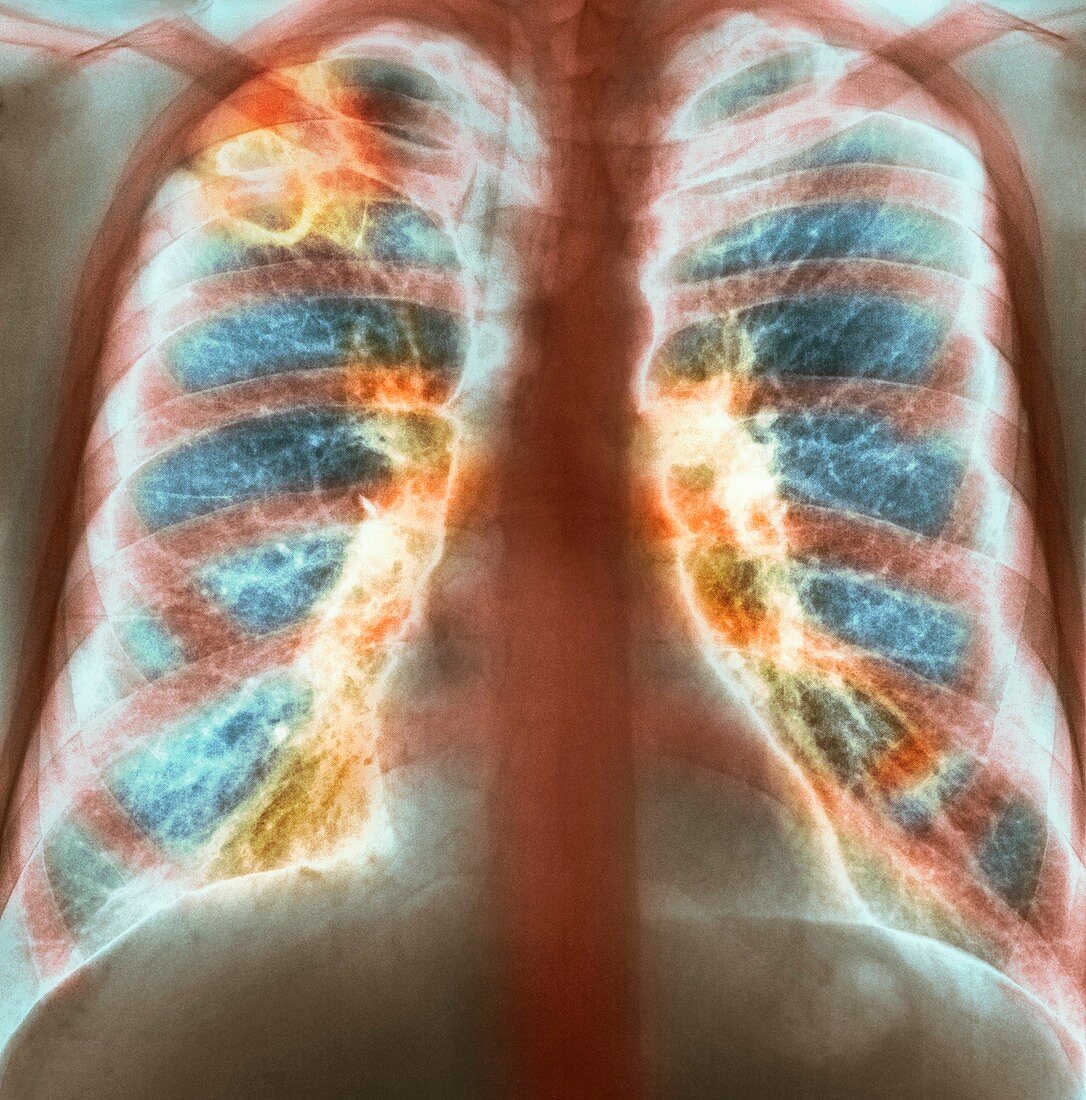 Drug use lung damage,X-ray