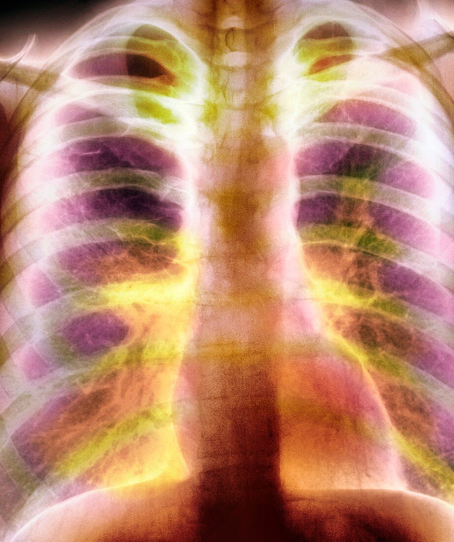 Bullous emphysema,X-ray