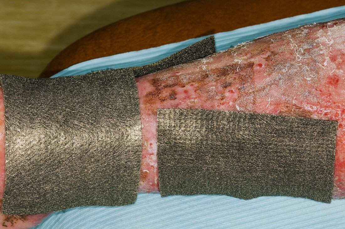 Acticoat treatment of varicose eczema