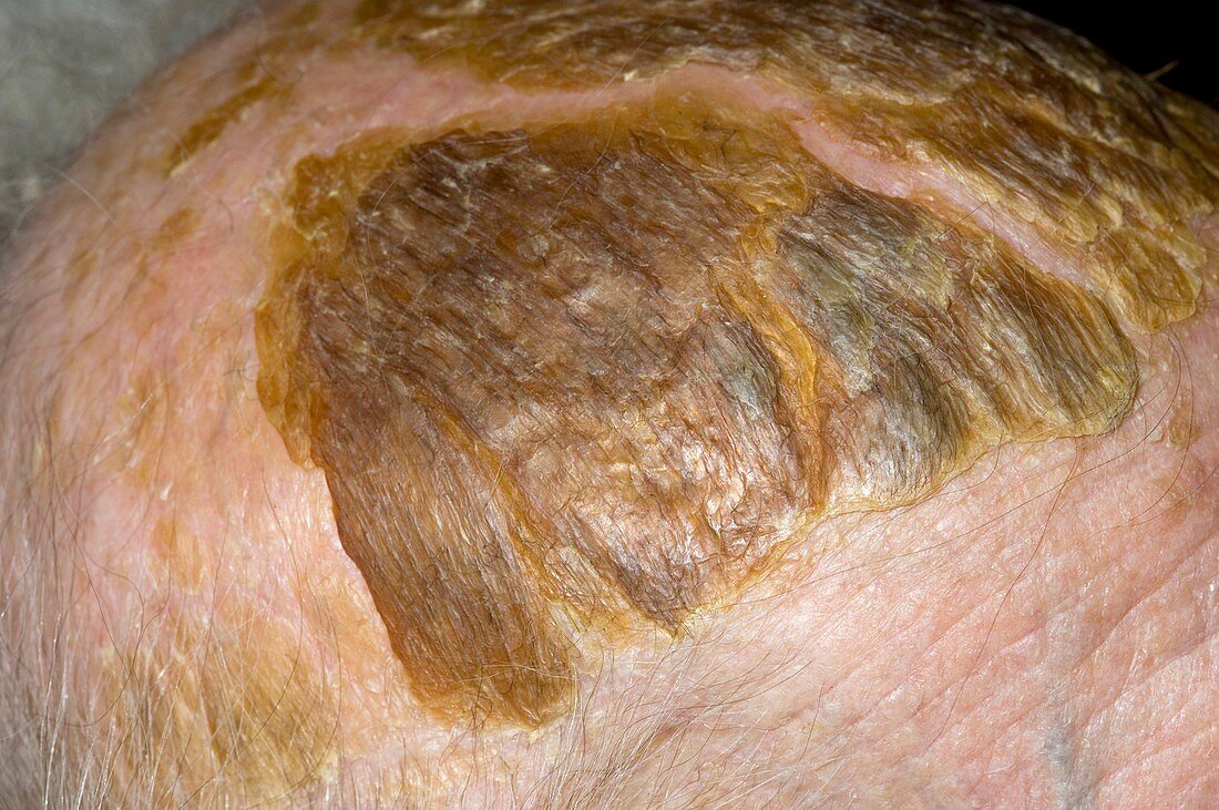 Seborrheic eczema on the scalp