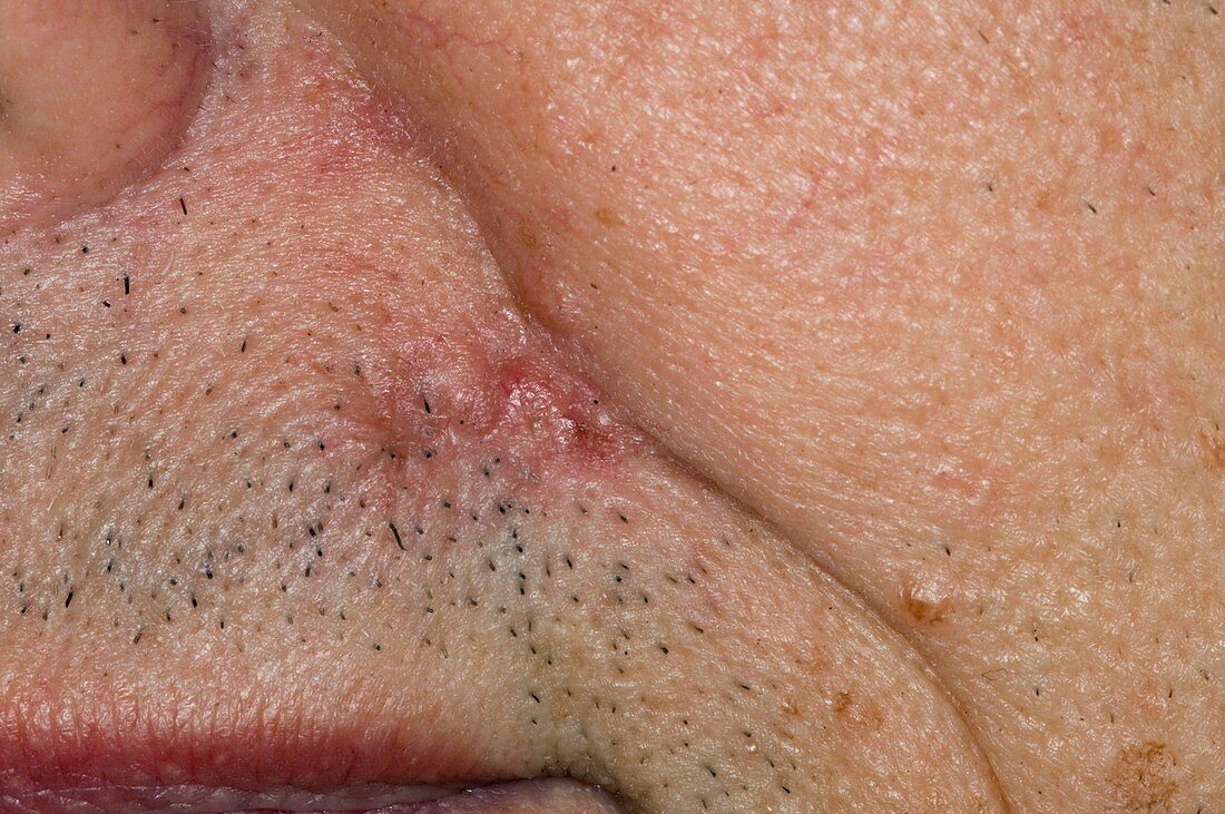 Excised pigmented mole (naevus)